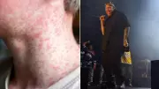 Measles Alert: Three Infectious Cases at Brisbane Jelly Roll Concert