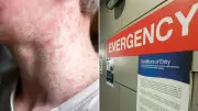 Measles Alerts Issued in NSW and WA After Overseas Travellers Return Infected