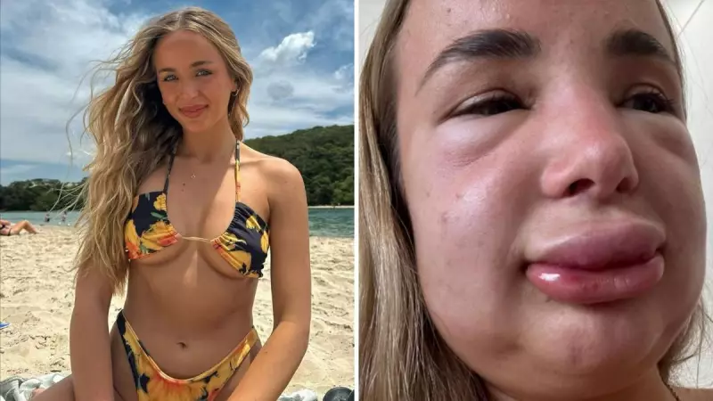 Aussie Influencer's Severe Allergic Reaction to Lip Filler Dissolving Goes Viral