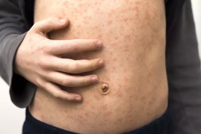 WA Health Issues Measles Alert for Fiona Stanley Hospital ED Exposure