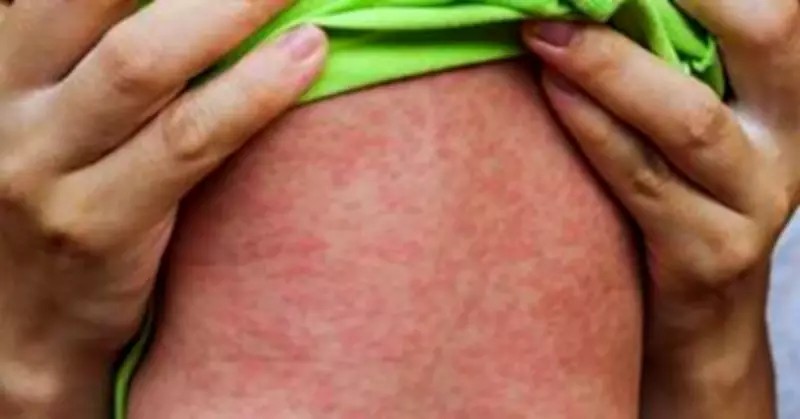 Canberra Measles Alert: Public Health Warning Issued for ACT Locations