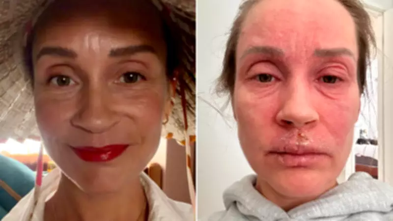 Gold Coast Woman's Harrowing Journey Through Topical Steroid Withdrawal