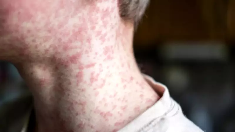 Measles Alert: Geelong and Surf Coast Exposure Sites Identified