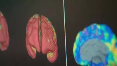 Gold Coast Grandmother's Remarkable Alzheimer's Recovery with New Drug