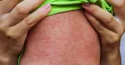 Canberra Measles Alert: Public Health Warning Issued for ACT Locations