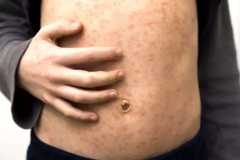 Measles Alert in Perth: Dome Cafe Among Exposure Sites After Bali Traveller Returns