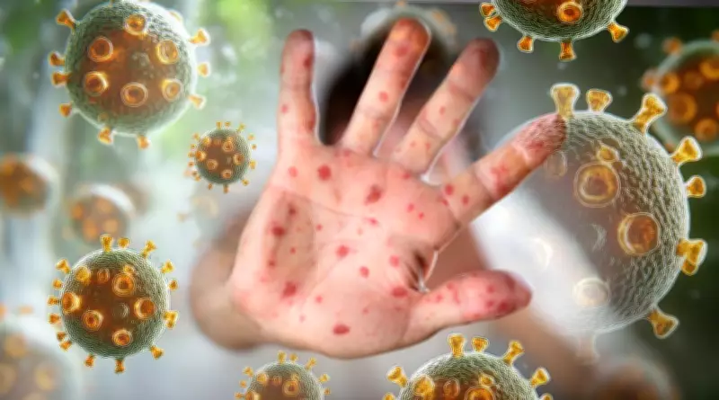 Measles Alert in Perth: St John of God Midland, Woolworths, Kmart Listed as Exposure Sites