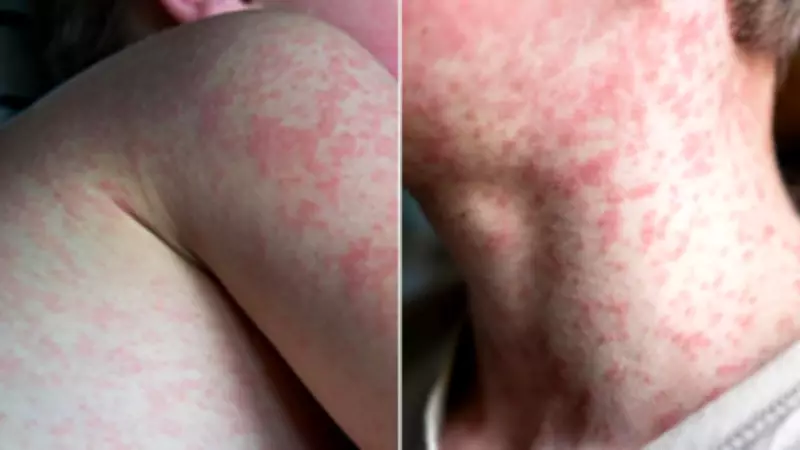 Measles Alert in Sydney After New Local Case Sparks Community Transmission Fears