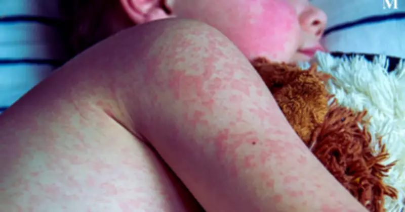 Measles Alert in Wollongong: Three New Cases Confirmed, Health Department Issues Warning