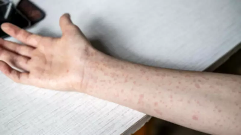 Measles Exposure Sites Identified Across Cairns Following Confirmed Case