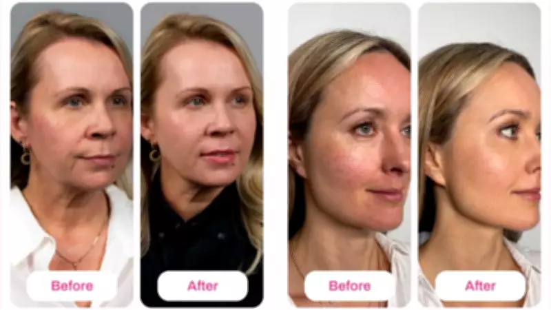 Salmon DNA Skincare Craze Hits Australia: At-Home Treatment Sells Out in Days