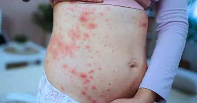 Measles Alert: Two New Cases Confirmed in Illawarra, Health Department Issues Warning