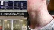 Measles Alert at Brisbane Airport After Infectious Cases Pass Through Terminal
