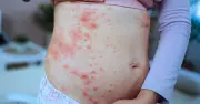 Measles Alert: Two New Cases Confirmed in Illawarra, Health Department Issues Warning