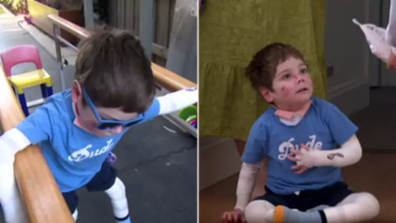 Butterfly boy walks again after groundbreaking gene therapy gel