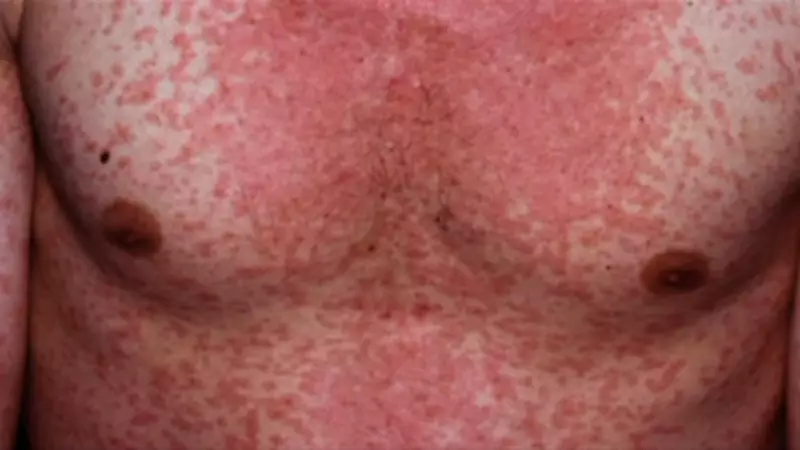 Measles cases surge in Australia, health authorities warn of undetected spread