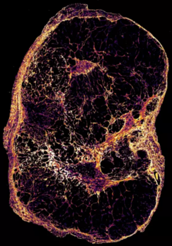 Slow-growing breast cancer cells cause late relapses, study finds