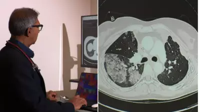 Early-Onset Bowel Cancer Now a 'New Disease' in Young Australians