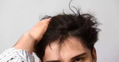 Hair Transplant in Turkey: What Australians Should Know Before Booking