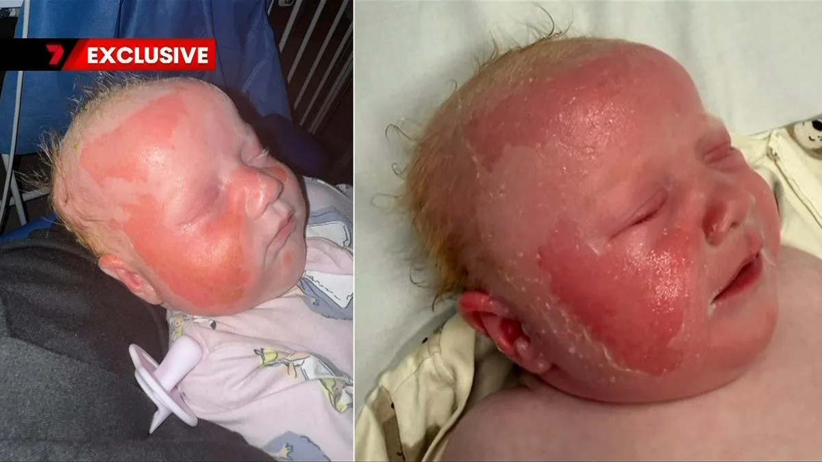 Reflective UV Rays Burn 10-Week-Old Baby in Perth