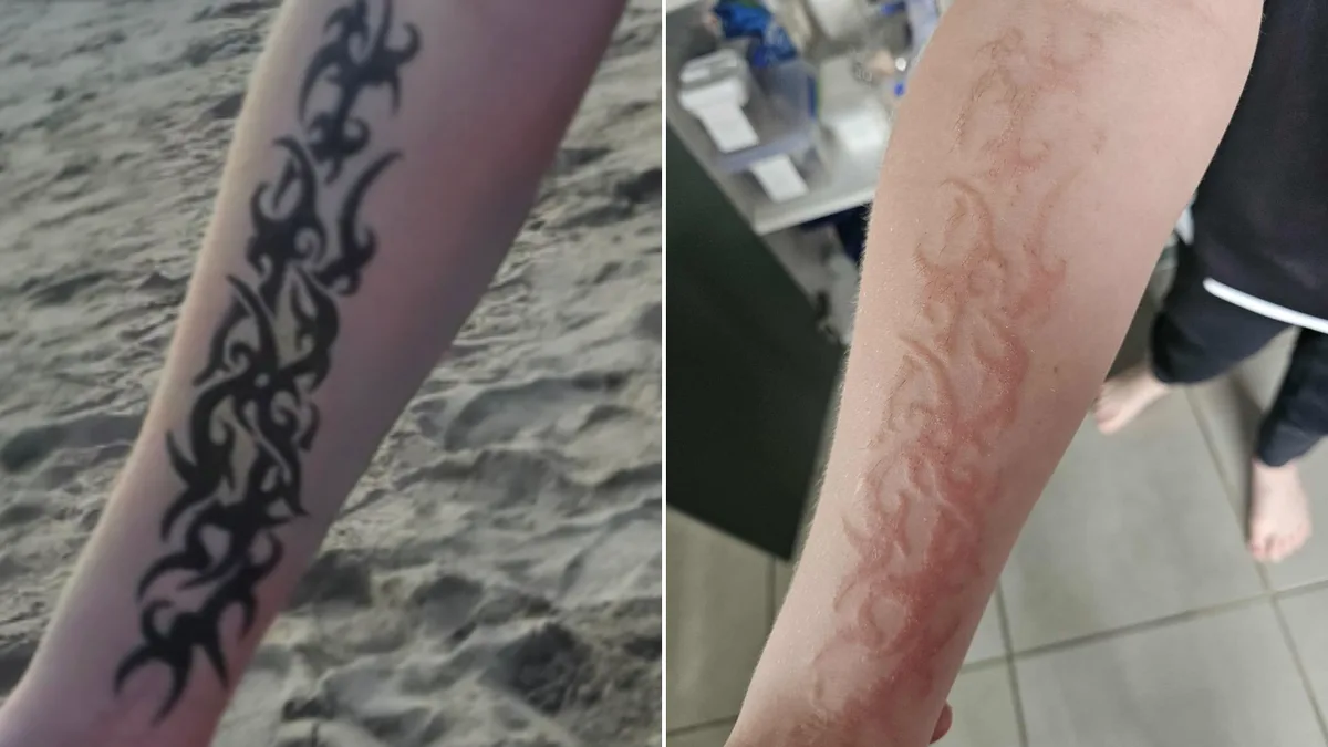 Black Henna Tattoo in Bali Leaves NZ Boy Scarred, Mother Warns Tourists