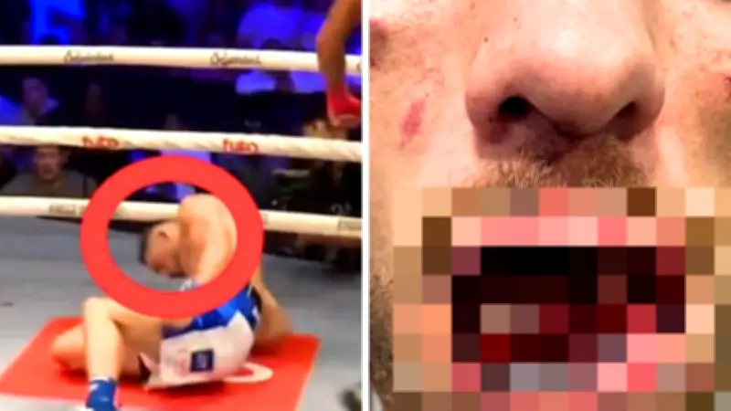 Bare Knuckle Boxer Retires After Gruesome Jaw and Teeth Injury