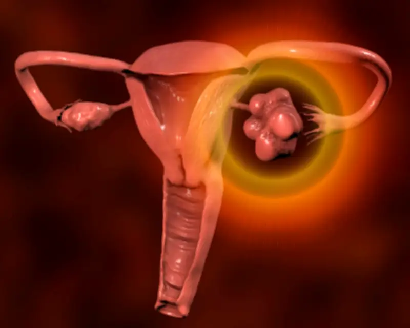 NHS Urges Women with Irregular Periods to Check for PMOS