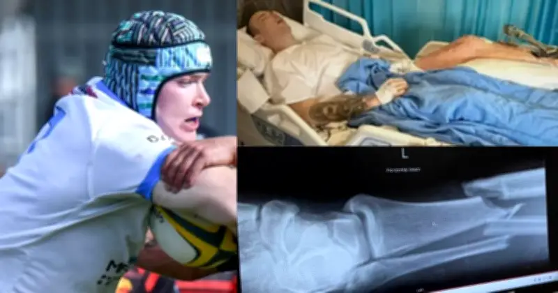 Queanbeyan Whites Star Arley Moore Suffers Broken Leg in ACT Rugby