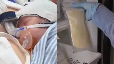 Donor Breast Milk Reduces Deadly Bowel Disease in Premature Babies by a Third