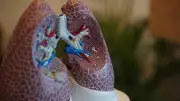 Australia's Lung Cancer Screening Program: A Year On, Health System Challenges Remain