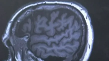 Australian Trial Aims for Early Alzheimer's Detection